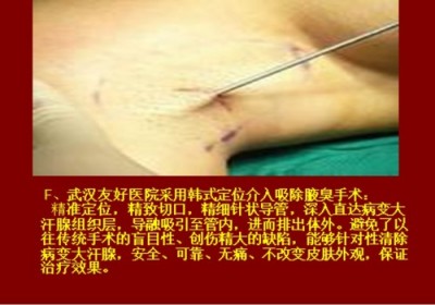 目前腋臭根治技术推广情况报告